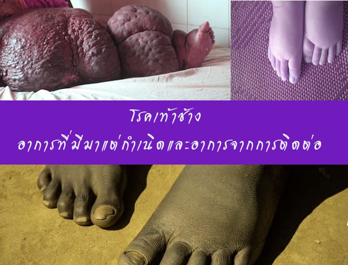 โรคเท้าช้าง